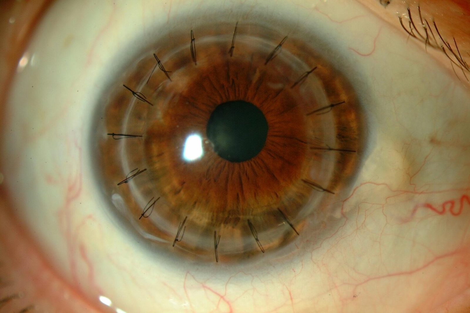 Lentes esclerales después de un trasplante de córnea