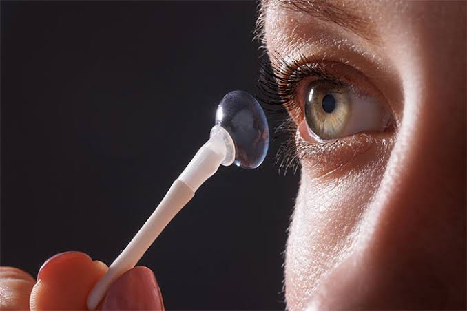Lentes esclerales para queratocono: guía completa