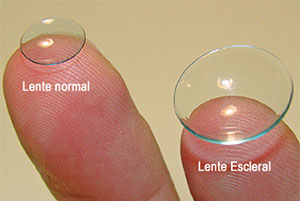 Lentes esclerales vs. rígidos e híbridos para queratocono